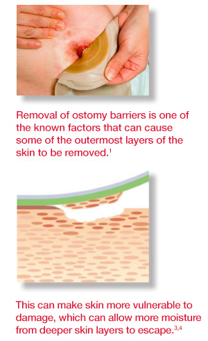 Ostomy Barrier